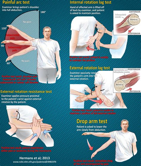 rotator cuff tear physical exam